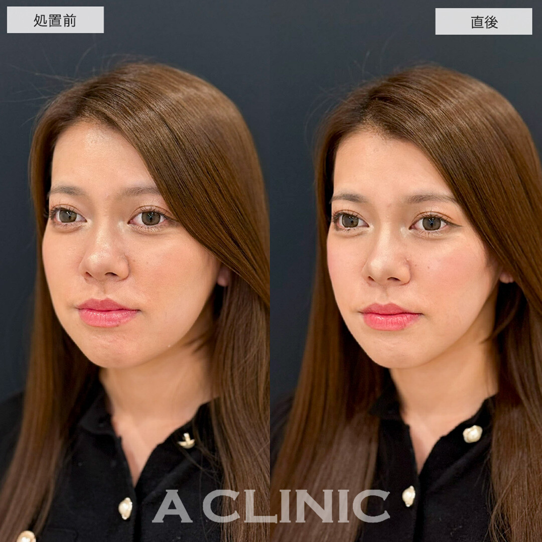 Aスレッドで理想の逆三角形の輪郭に!こちら処置前と直後の症例です(20代女性)