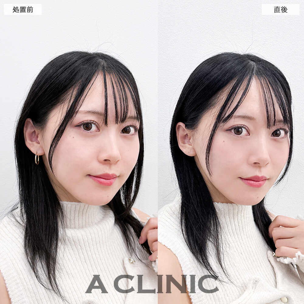 Aスレッドで膨らみのあった輪郭が滑らかになりました！こちら処置前と直後の症例です(20代女性)