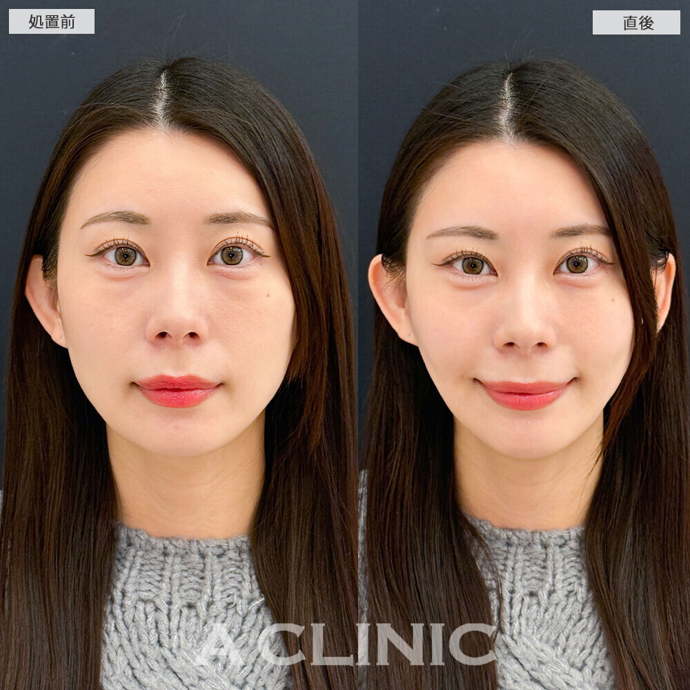 Aスレッドでもたつき解消！こちら処置前と直後の症例です(30代女性)