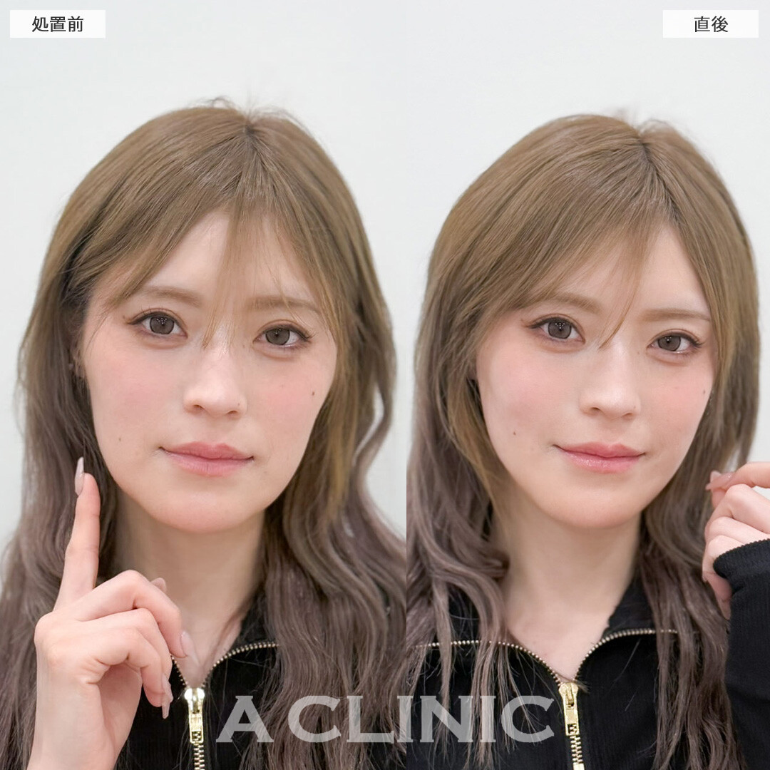 Aスレッドで手軽に理想のVフェイスを手に入れられます！こちら処置前と直後の症例です(30代女性)