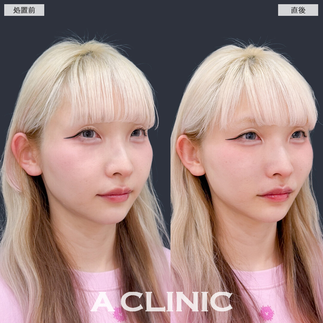 Aスレッドでフェイスラインを整えリフトアップすることで若返って見えます！こちら処置前と直後の症例です(30代女性)