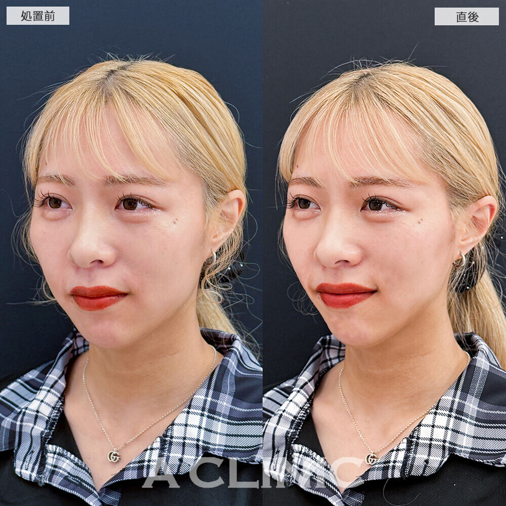 Aスレッドでフェイスラインの左右差を整えます！こちら処置前と直後の症例です(20代女性)