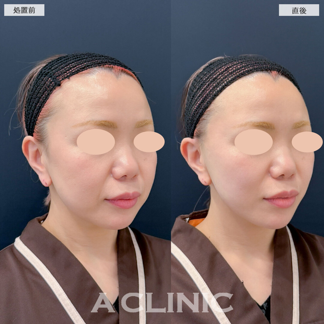 Aスレッドで口横のたるみがしっかり引きあがり若々しい印象になりました！こちら処置前と直後の症例です(40代女性)