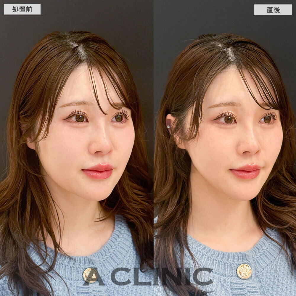 Aスレッドで丸顔改善！こちら処置前と直後の症例です(20代女性)