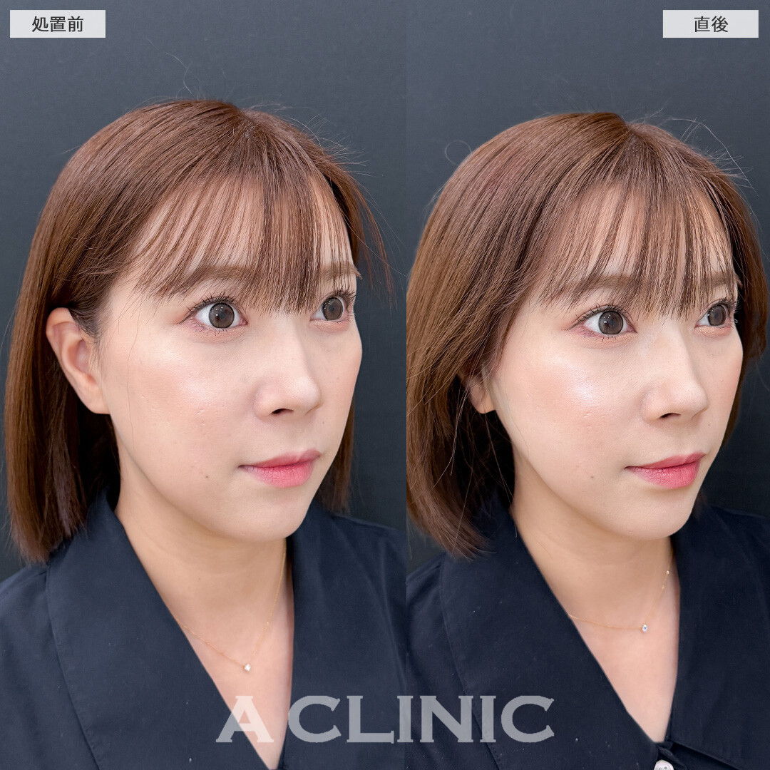 Aスレッドはお顔の左右差もなくすことができます！こちら処置前と直後の症例です(30代女性)