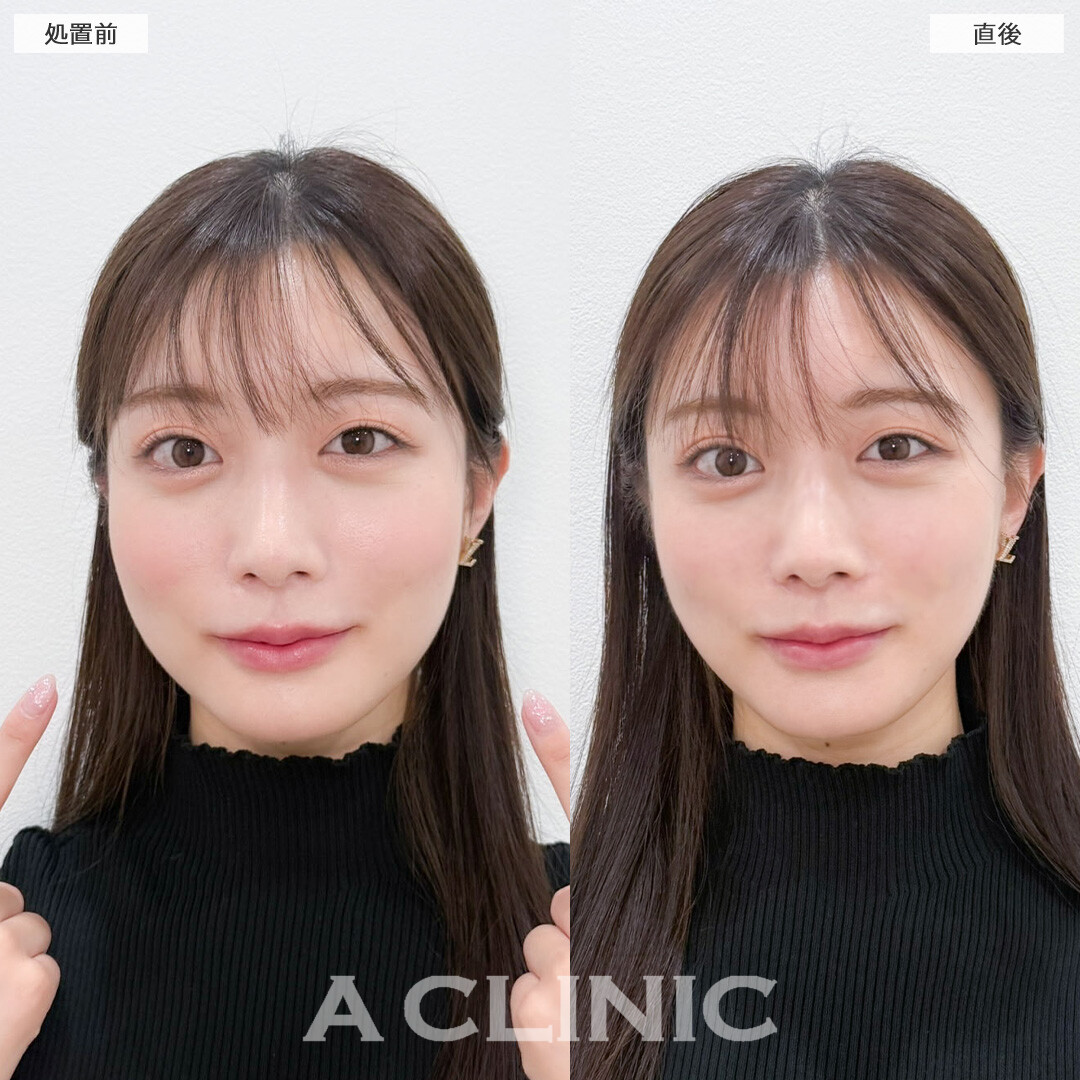 Aスレッドで左右差ともたつきを解消！こちら処置前と直後の症例です(20代女性)