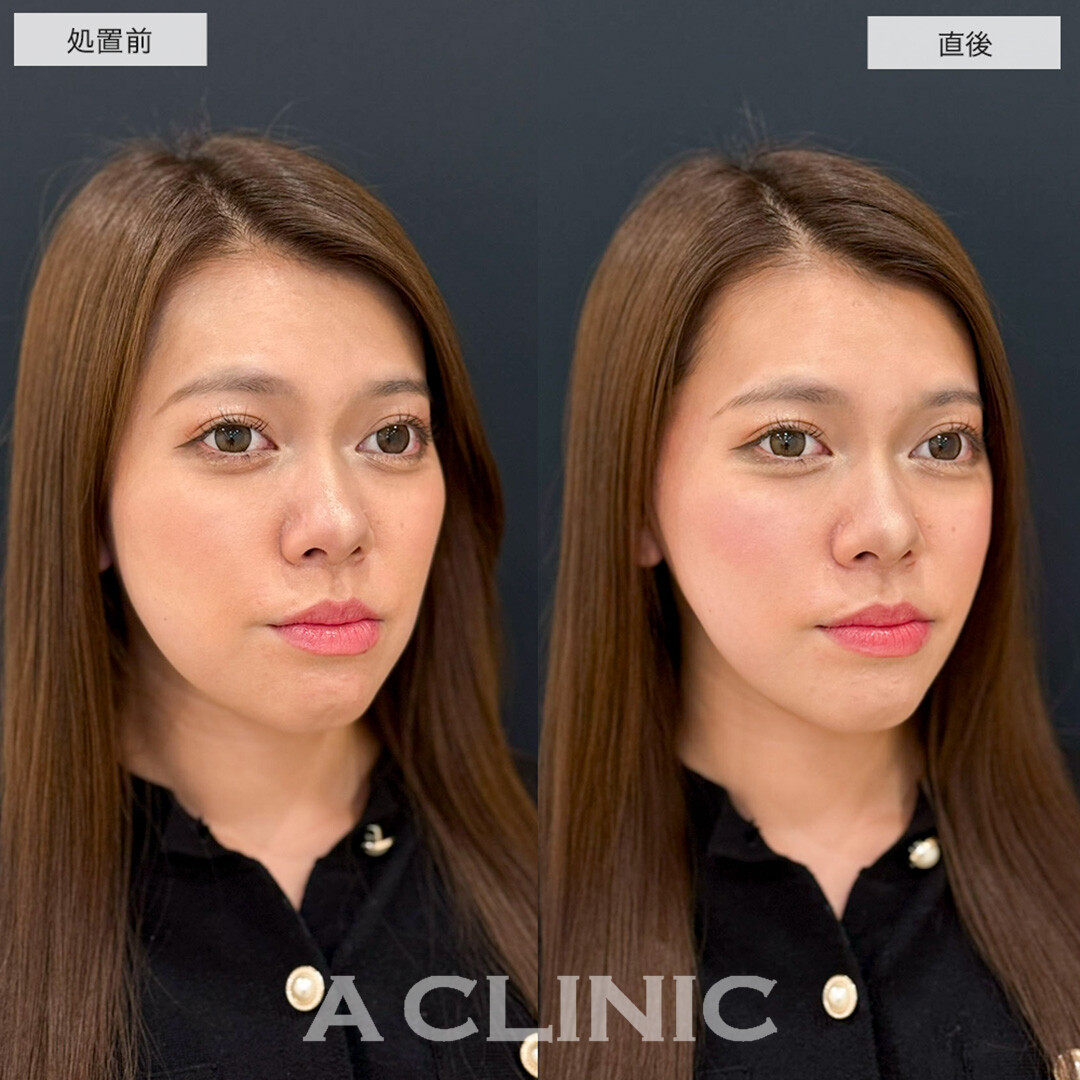 Aスレッドで理想の逆三角形の輪郭に!こちら処置前と直後の症例です(20代女性)