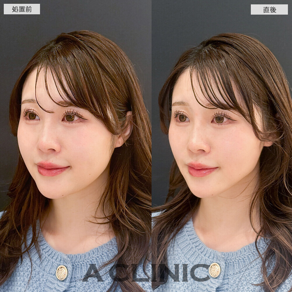 Aスレッドで丸顔改善！こちら処置前と直後の症例です(20代女性)