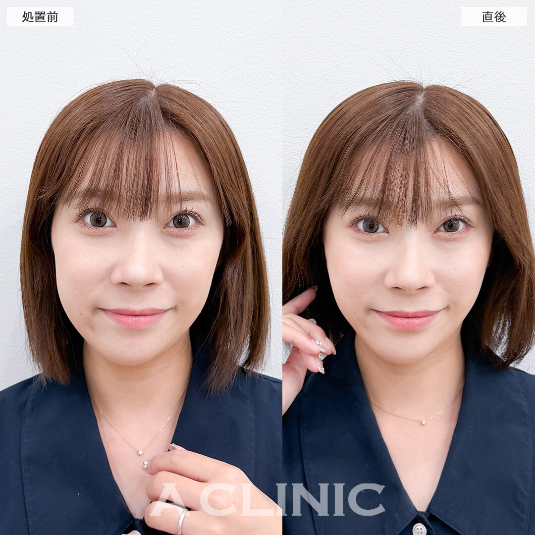 Aスレッドはお顔の左右差もなくすことができます！こちら処置前と直後の症例です(30代女性)
