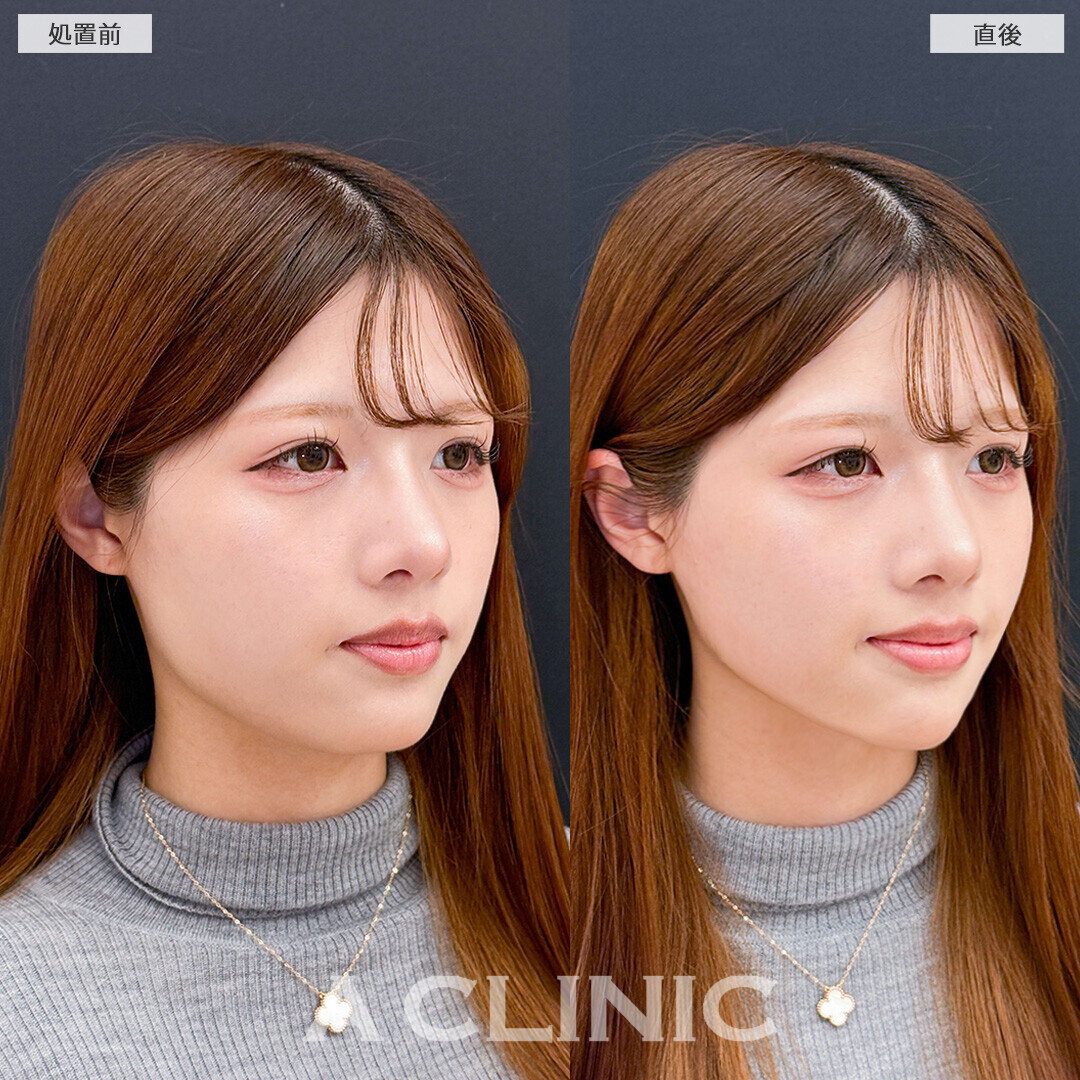 Aスレッドなら即日憧れのVフェイスに！こちら処置前と直後の症例です(10代女性)