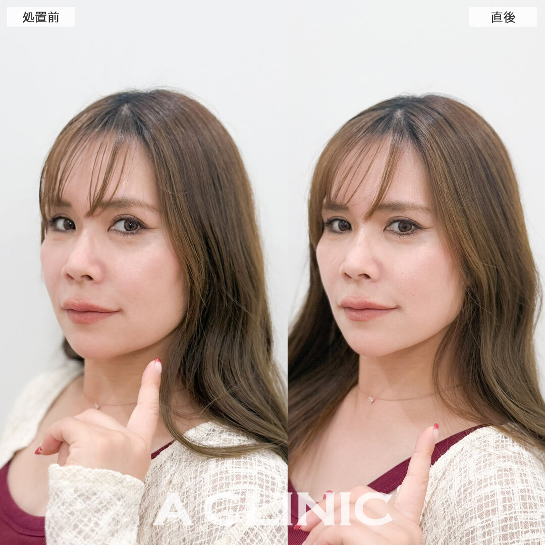 Aスレッドでなめらかなフェイスラインに！こちら処置前と直後の症例です(40代女性)