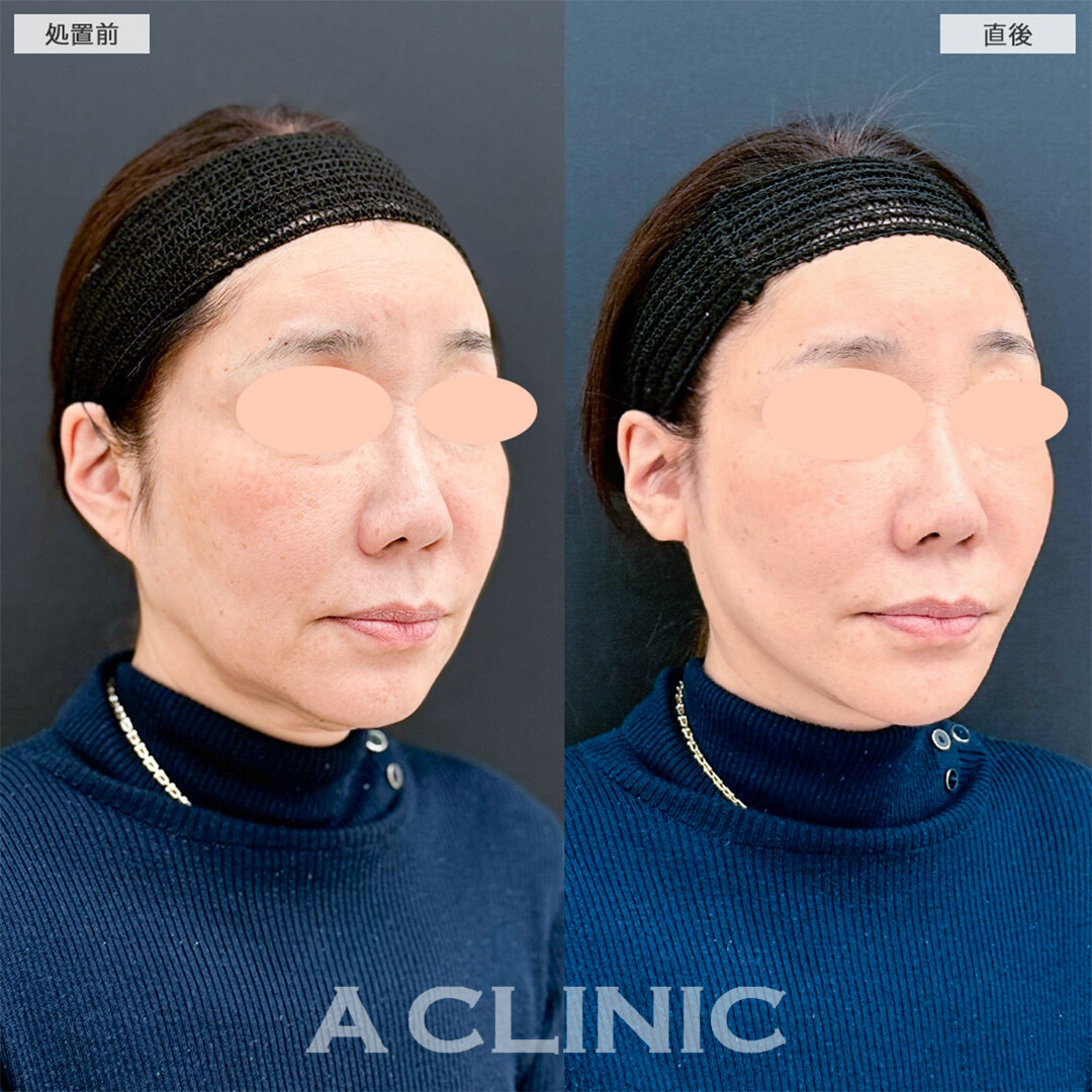 Aスレッドは頑固なたるみもたった15分で解決できます！こちら処置前と直後の症例です(50代女性)