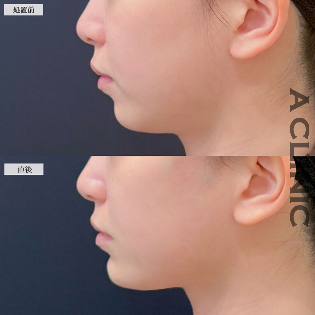 Aスレッドとあごへのヒアルロン酸注入で綺麗な卵型の輪郭になりました！こちら処置前と直後の症例です(30代女性)