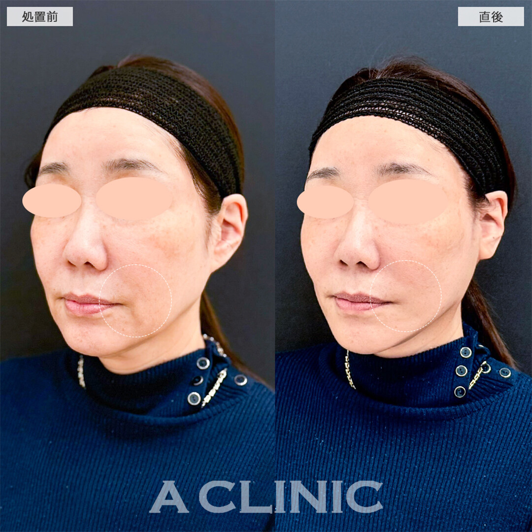 Aスレッドは頑固なたるみもたった15分で解決できます！こちら処置前と直後の症例です(50代女性)