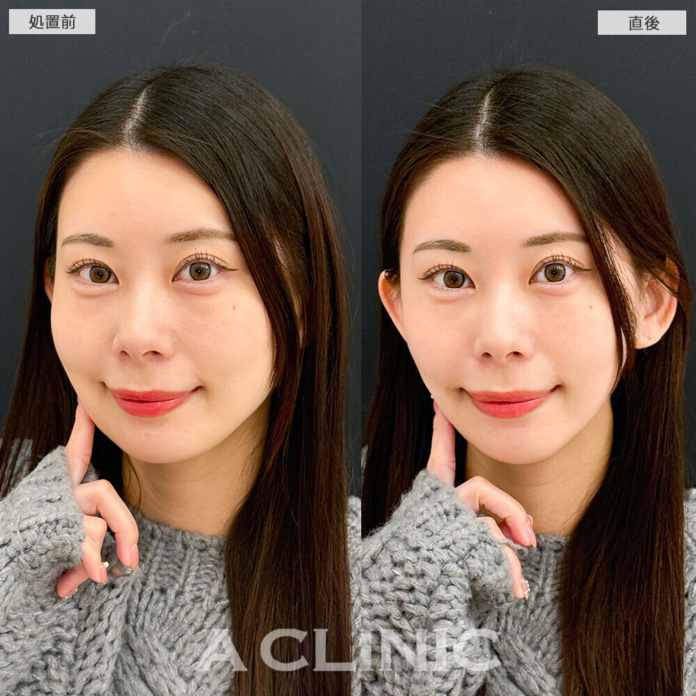 Aスレッドでもたつき解消！こちら処置前と直後の症例です(30代女性)