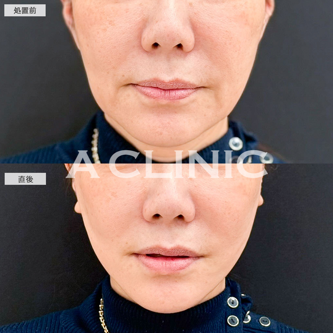 Aスレッドは頑固なたるみもたった15分で解決できます！こちら処置前と直後の症例です(50代女性)