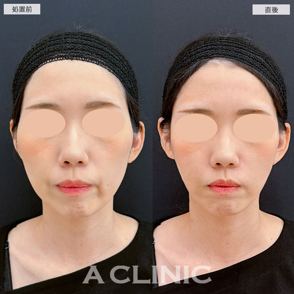 Aスレッドとヒアルロン酸注射(シワ)で老け顔解消！こちら処置前と直後の症例です(40代女性)