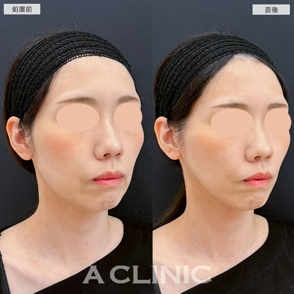 Aスレッドとヒアルロン酸注射(シワ)で老け顔解消！こちら処置前と直後の症例です(40代女性)