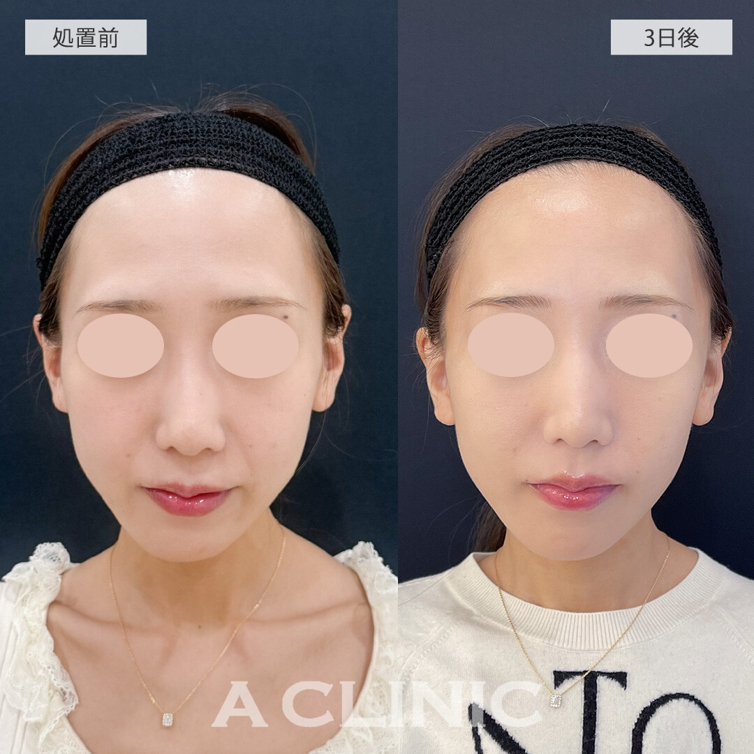 ほうれい線を改善し若々しい印象に！Aスレッドとバーティカルリフトの処置前と3日後の症例です(30代女性)