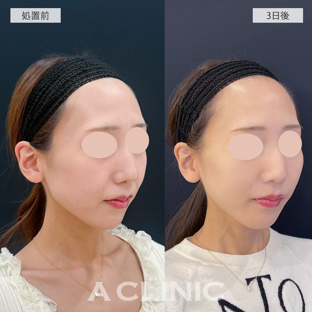 ほうれい線を改善し若々しい印象に！Aスレッドとバーティカルリフトの処置前と3日後の症例です(30代女性)
