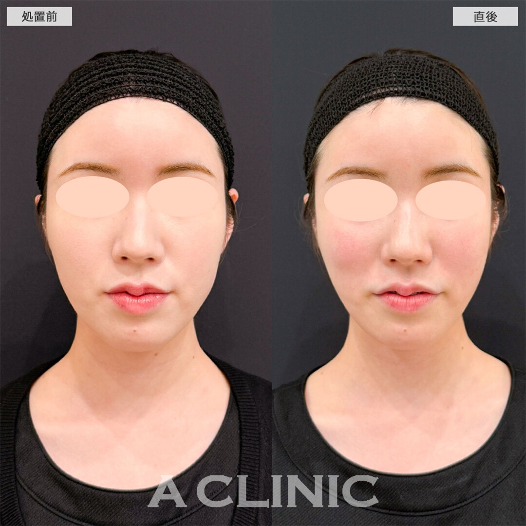 バーティカルリフトでチークトップの位置が高くなりバブみのあるお顔へ！こちら処置前と直後の症例です(20代女性)