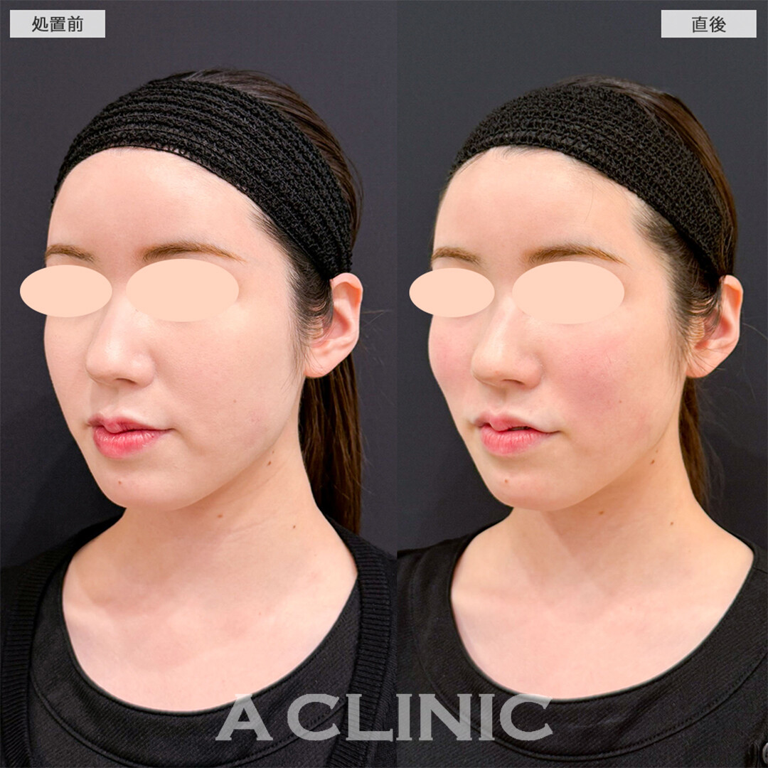 バーティカルリフトでチークトップの位置が高くなりバブみのあるお顔へ！こちら処置前と直後の症例です(20代女性)