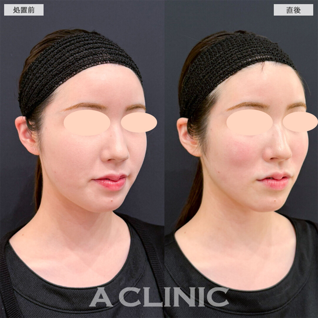 バーティカルリフトでチークトップの位置が高くなりバブみのあるお顔へ！こちら処置前と直後の症例です(20代女性)