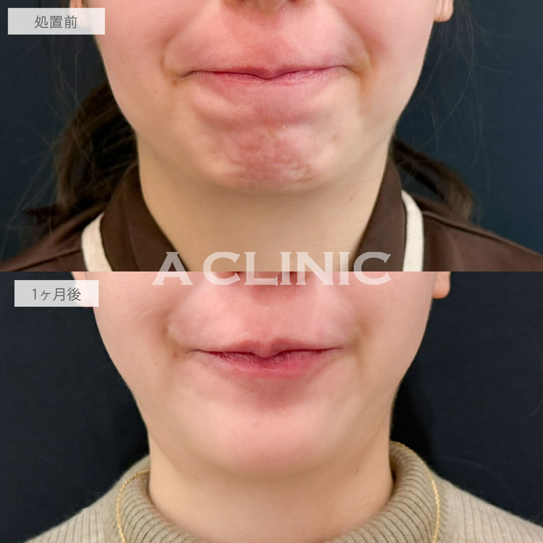 ボトックス注射(しわ)であごの梅干しジワをなくせます！こちら処置前と1か月後の症例です(30代女性)