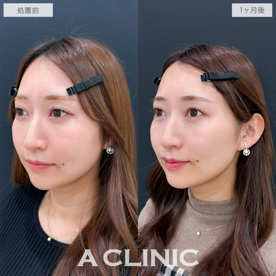 小顔エラボトックスとボトックス注射(しわ)で小顔もシワ予防も口角挙上も叶いました！こちら処置前と1か月後の症例です(30代女性)