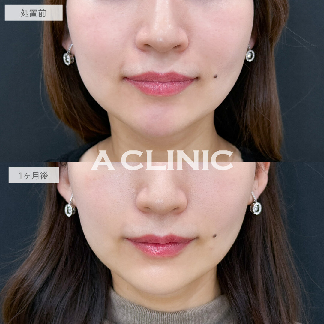 小顔エラボトックスとボトックス注射(しわ)で小顔もシワ予防も口角挙上も叶いました！こちら処置前と1か月後の症例です(30代女性)