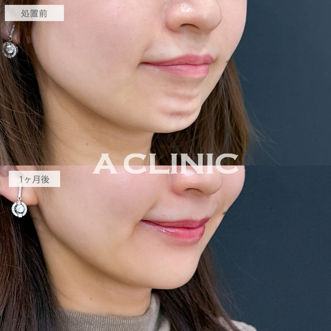 小顔エラボトックスとボトックス注射(しわ)で小顔もシワ予防も口角挙上も叶いました！こちら処置前と1か月後の症例です(30代女性)