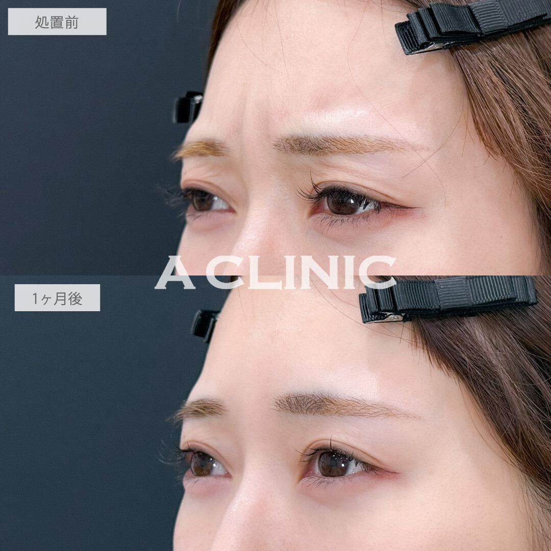 小顔エラボトックスとボトックス注射(しわ)で小顔もシワ予防も口角挙上も叶いました！こちら処置前と1か月後の症例です(30代女性)