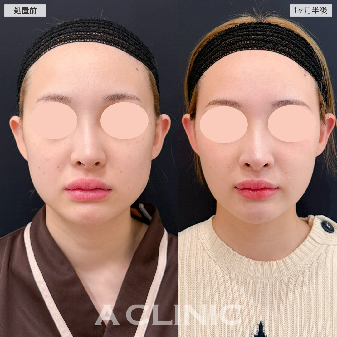 バッカルファット除去術とエラ下・あご下の脂肪吸引で顔周りの余分な脂肪とおさらば！処置前と1ヶ月半後の症例です(20代女性)