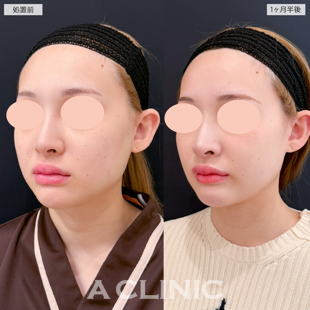 バッカルファット除去術とエラ下・あご下の脂肪吸引で顔周りの余分な脂肪とおさらば！処置前と1ヶ月半後の症例です(20代女性)