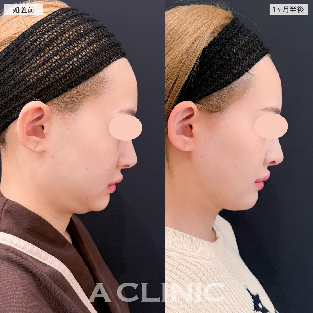 バッカルファット除去術とエラ下・あご下の脂肪吸引で顔周りの余分な脂肪とおさらば！処置前と1ヶ月半後の症例です(20代女性)