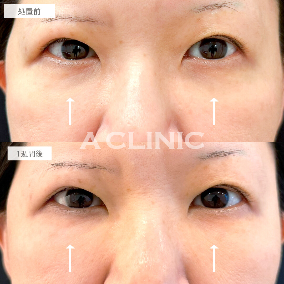 A式コンシーラー注射で目の下のくぼみを改善！処置前と1週間後の症例です(50代女性)