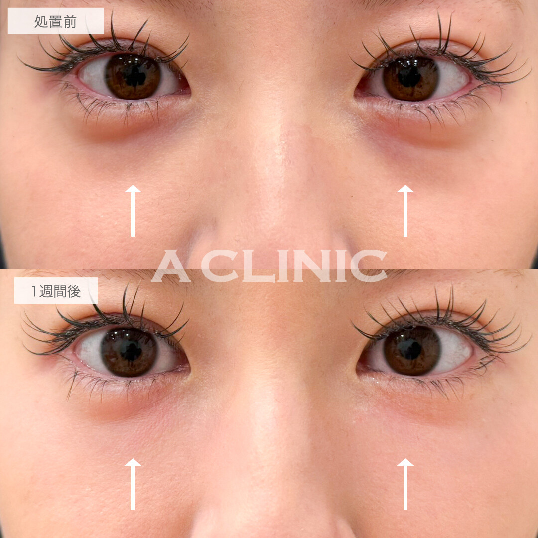 A式コンシーラー注射でふっくら若々しいお目元に！処置前と1週間後の症例です(20代女性)