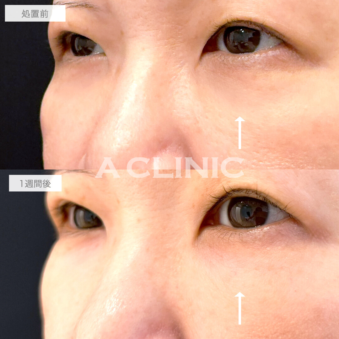 A式コンシーラー注射で目の下のくぼみを改善！処置前と1週間後の症例です(50代女性)