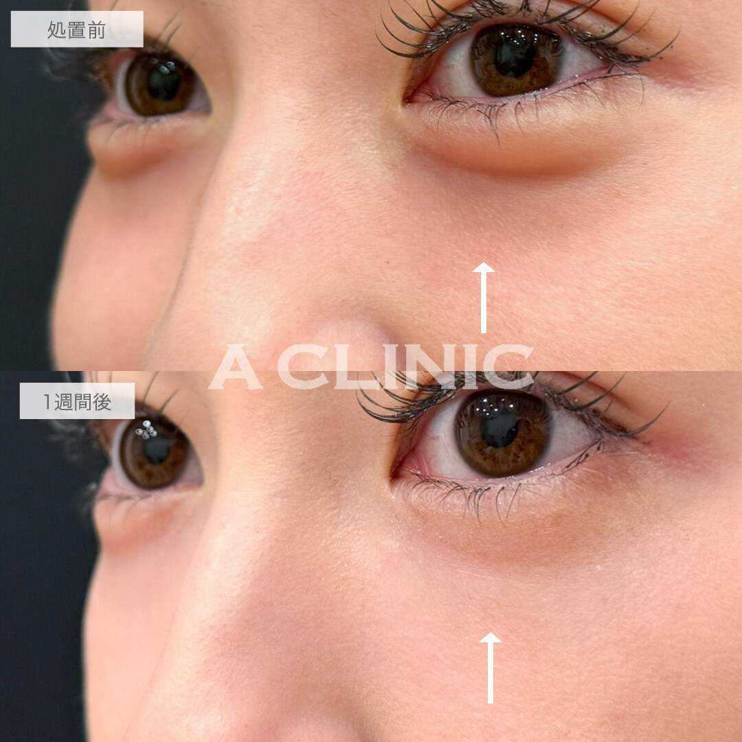 A式コンシーラー注射でふっくら若々しいお目元に！処置前と1週間後の症例です(20代女性)