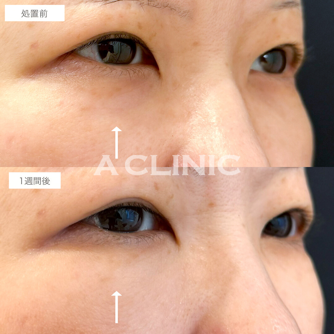A式コンシーラー注射で目の下のくぼみを改善！処置前と1週間後の症例です(50代女性)