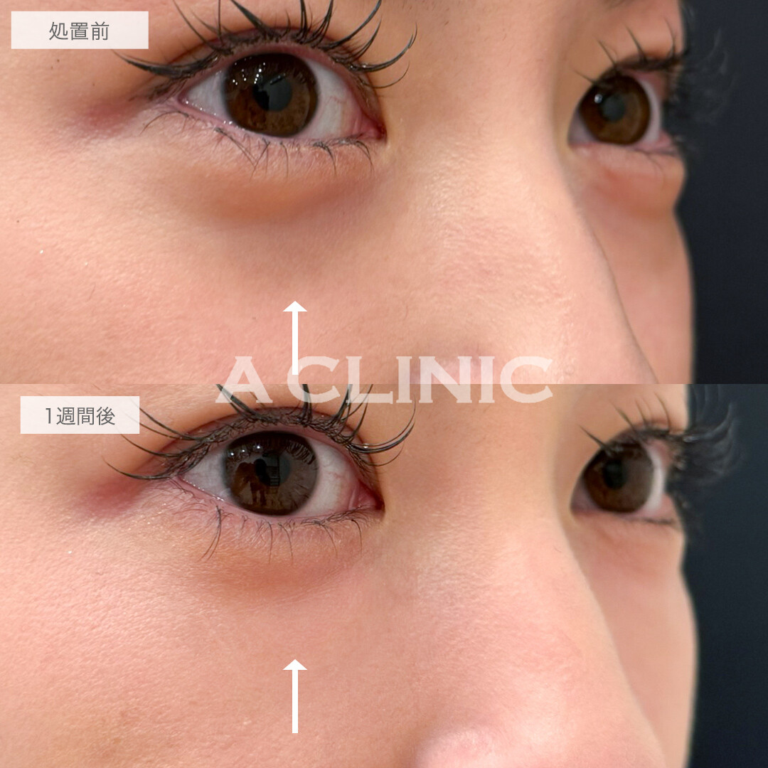 A式コンシーラー注射でふっくら若々しいお目元に！処置前と1週間後の症例です(20代女性)