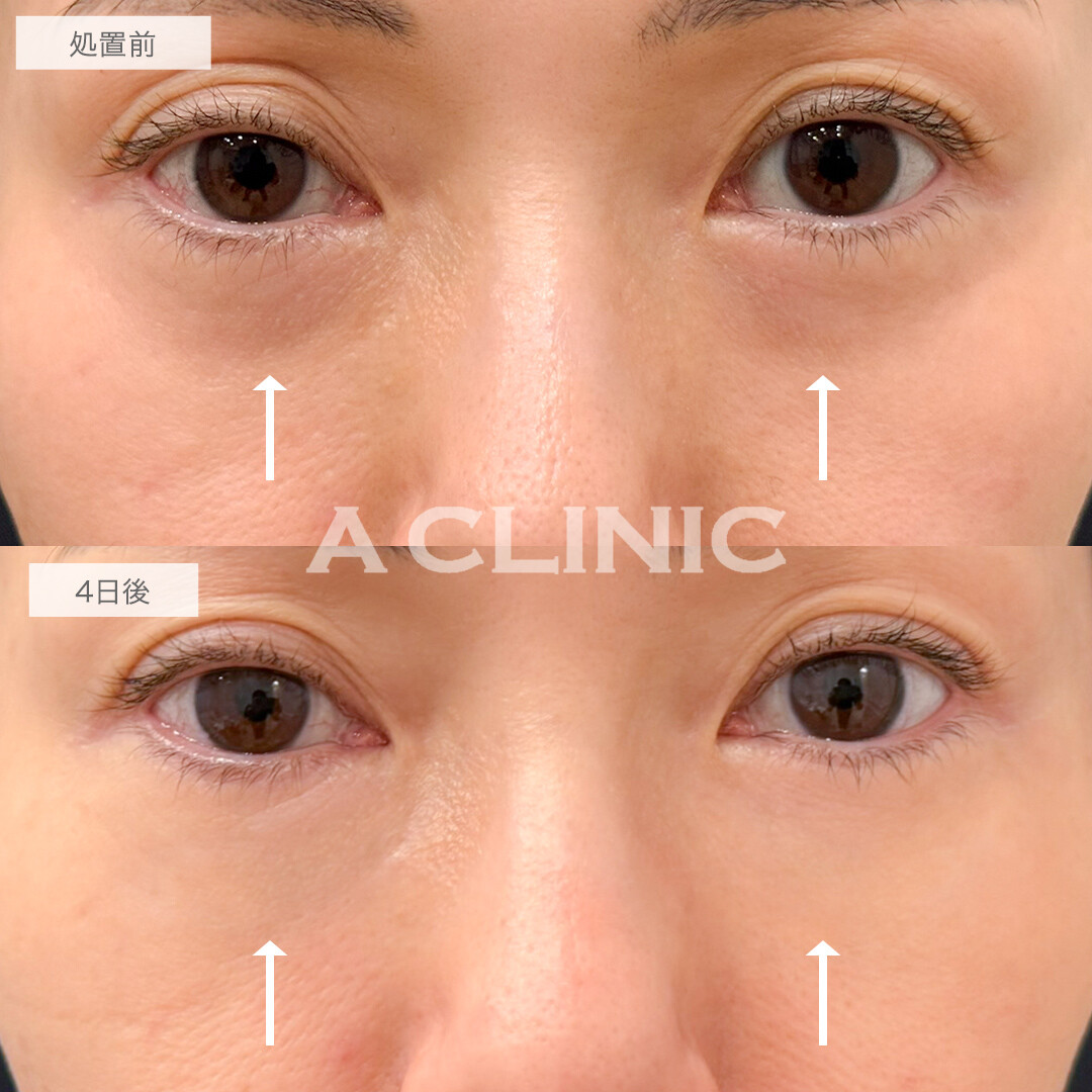 A式コンシーラー注射で目元のハリが蘇る！処置前と4日後の症例です(40代女性)