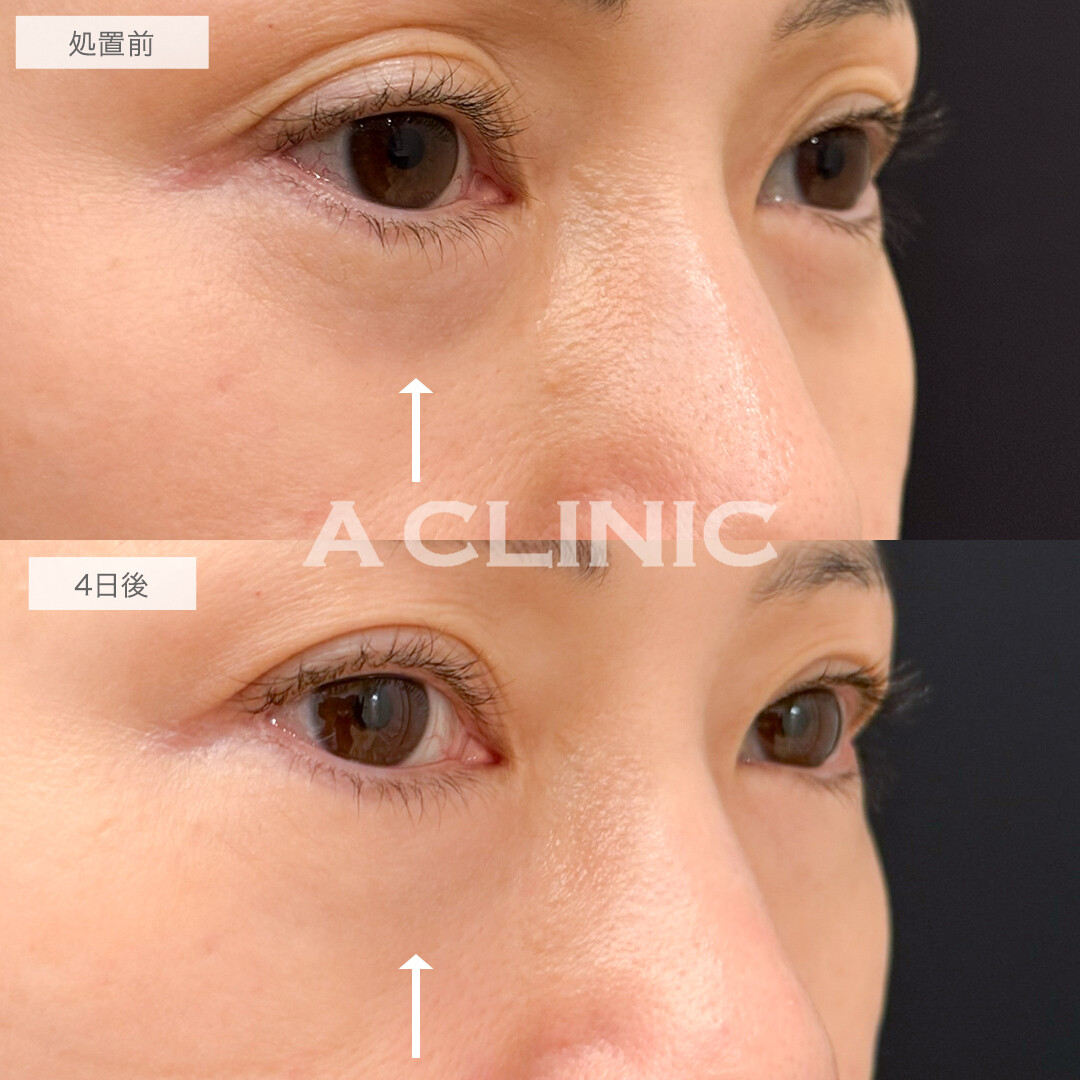 A式コンシーラー注射で目元のハリが蘇る！処置前と4日後の症例です(40代女性)