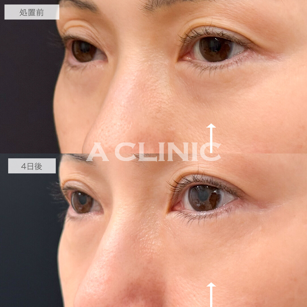 A式コンシーラー注射で目元のハリが蘇る！処置前と4日後の症例です(40代女性)