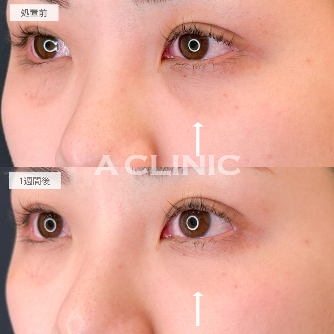 A式コンシーラー注射で目元のくすみと小じわが改善されメイクノリが良くなりました！こちら処置前と1週間後の症例です(20代女性)