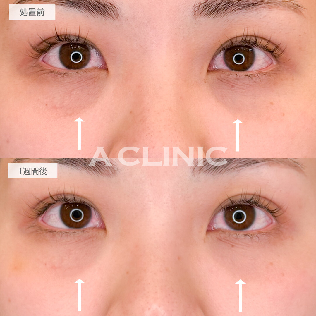 A式コンシーラー注射で目元のくすみと小じわが改善されメイクノリが良くなりました！こちら処置前と1週間後の症例です(20代女性)