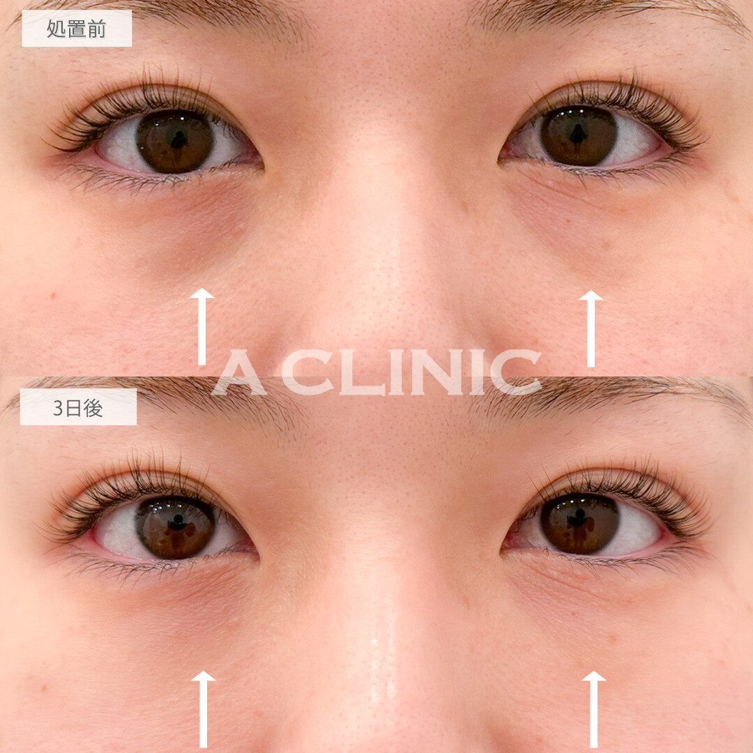 A式コンシーラー注射でメイクでも隠せなかった黒クマがすっぴんでも気にならなくなりました！こちら処置前と3日後の症例です(30代女性)