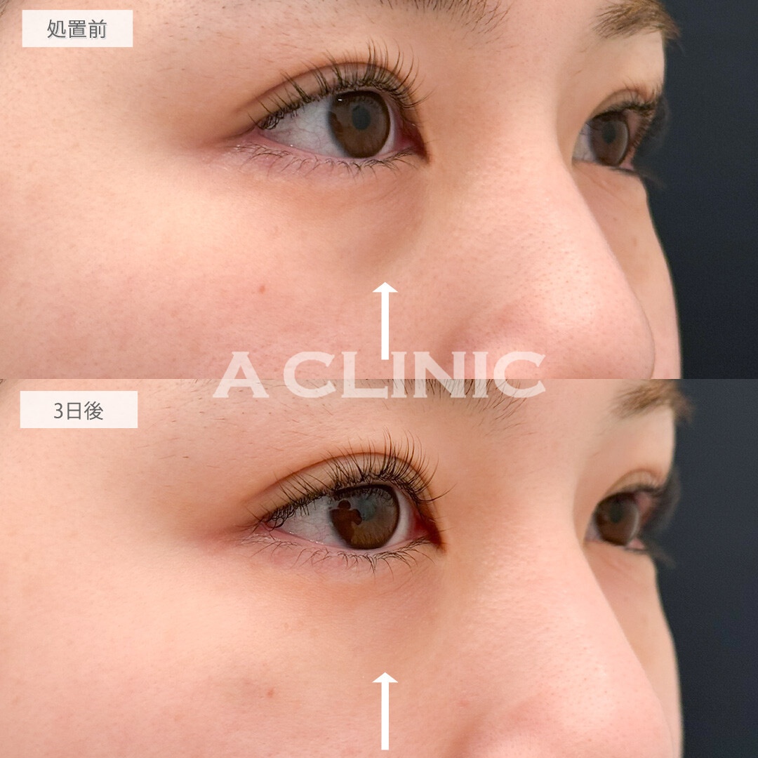 A式コンシーラー注射でメイクでも隠せなかった黒クマがすっぴんでも気にならなくなりました！こちら処置前と3日後の症例です(30代女性)