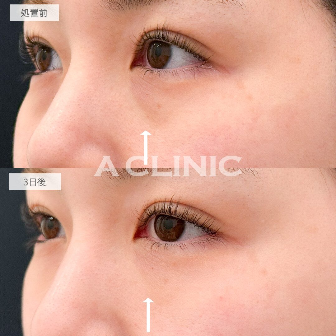 A式コンシーラー注射でメイクでも隠せなかった黒クマがすっぴんでも気にならなくなりました！こちら処置前と3日後の症例です(30代女性)