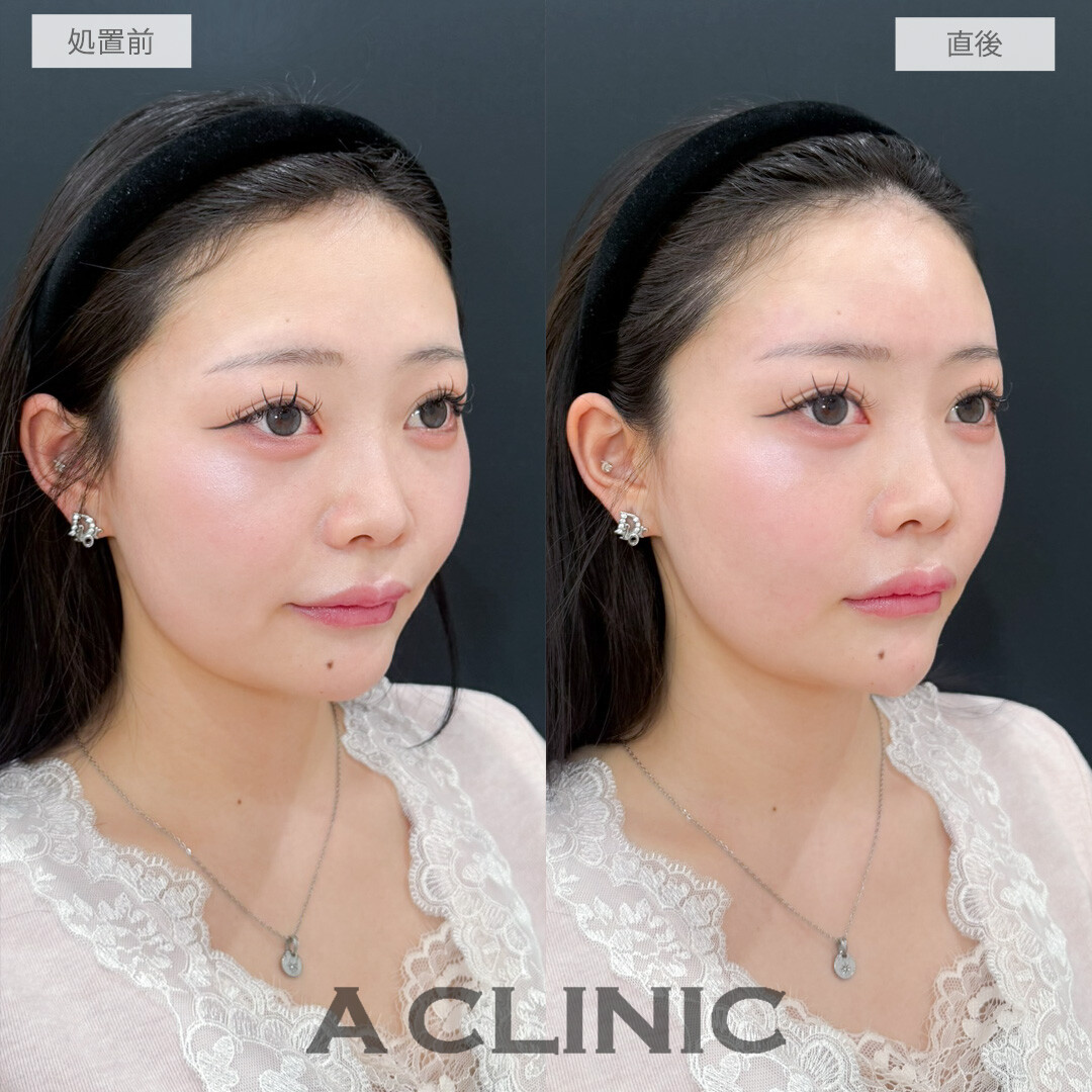 ヒアルロン酸カスタマイズメニューですっぴんでも盛れるメリハリのあるお顔に変化！処置前と直後の症例です(20代女性)